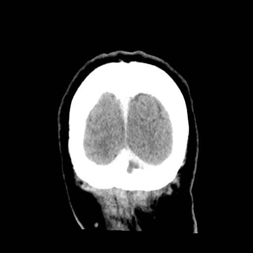 Cerebral metastasis to basal ganglia (Radiopaedia 81568-95412 Coronal C+ delayed 56).png