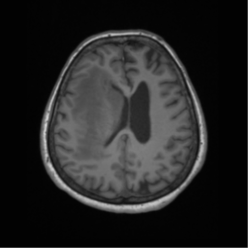 Cerebral metastasis to basal ganglia (Radiopaedia 81568-95413 Axial T1 49).png
