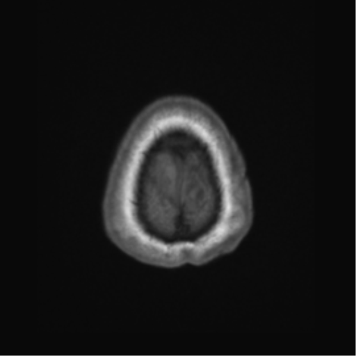 Cerebral metastasis to basal ganglia (Radiopaedia 81568-95413 Axial T1 72).png
