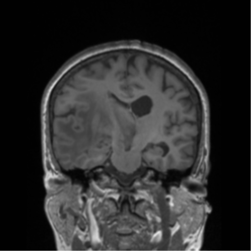 Cerebral metastasis to basal ganglia (Radiopaedia 81568-95413 Coronal T1 24).png