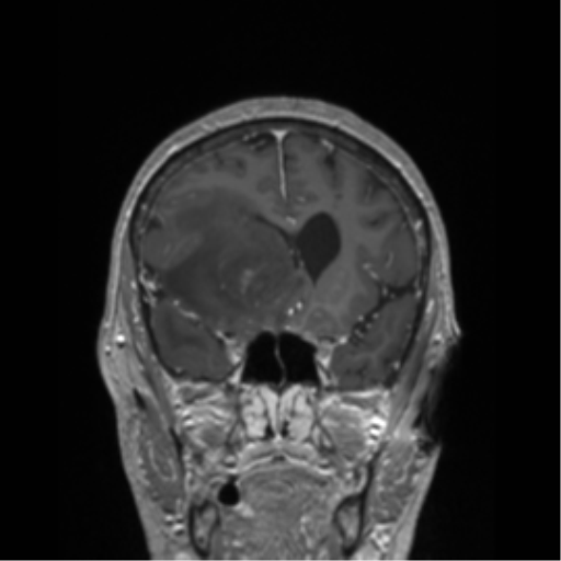 File:Cerebral metastasis to basal ganglia (Radiopaedia 81568-95413 Coronal T1 C+ 41).png