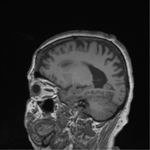 Cerebral metastasis to basal ganglia (Radiopaedia 81568-95413 Sagittal T1 23).png