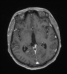 Cerebral toxoplasmosis (Radiopaedia 43956-47461 Axial T1 C+ 34).jpg