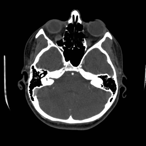 Cerebral venous sinus thrombosis (Radiopaedia 40619-43227 A 58).jpg