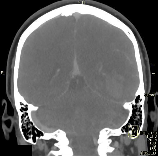 File:Cerebral venous sinus thrombosis (Radiopaedia 91329-108965 Coronal venogram 60).jpg