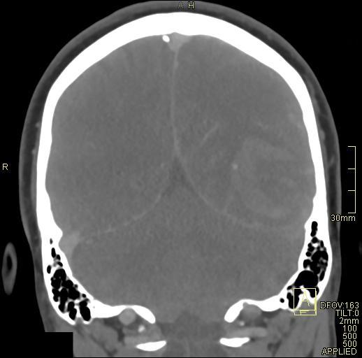 Cerebral venous sinus thrombosis (Radiopaedia 91329-108965 Coronal venogram 64).jpg