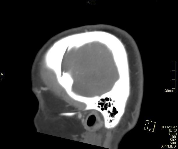 Cerebral venous sinus thrombosis (Radiopaedia 91329-108965 Sagittal venogram 9).jpg