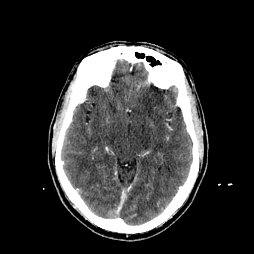 File:Cerebral venous thrombosis (CVT) (Radiopaedia 77524-89685 Axial with contrast 17).jpg