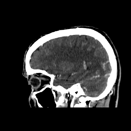 File:Cerebral venous thrombosis (CVT) (Radiopaedia 77524-89685 Sagittal CTV 11).jpg