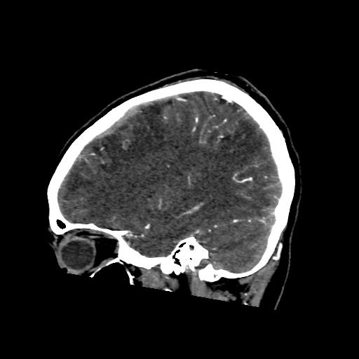 File:Cerebral venous thrombosis - hemorrhagic venous infarction (Radiopaedia 87318-103613 Sagittal 19).jpg