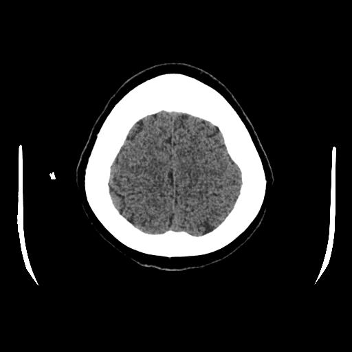 Cerebral venous thrombosis with venous hemorrhagic infarct (Radiopaedia 90354-107660 Axial non-contrast 44).jpg