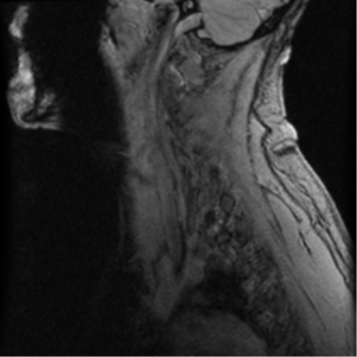 File:Cervical canal stenosis with cord compression (Radiopaedia 34114-35374 D 5).png