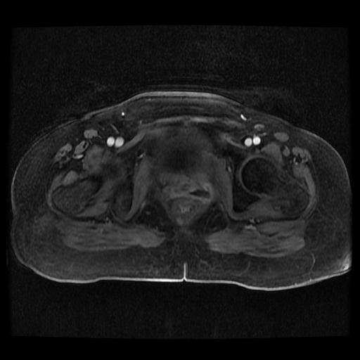 Cervical carcinoma (Radiopaedia 70924-81132 Axial T1 C+ fat sat 122).jpg