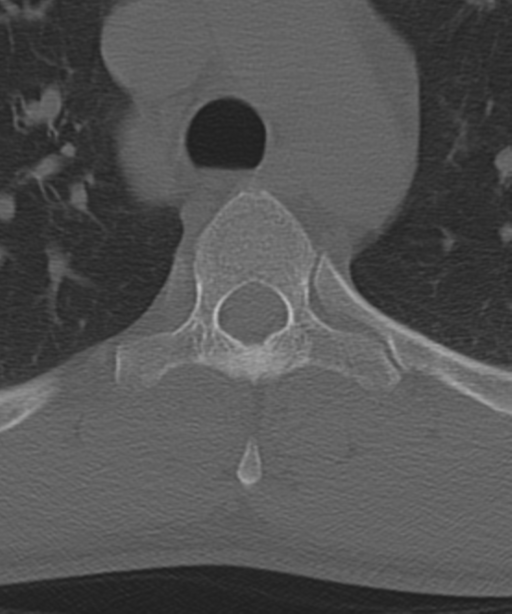 Cervical intercalary bone (Radiopaedia 35211-36748 Axial bone window 80).png