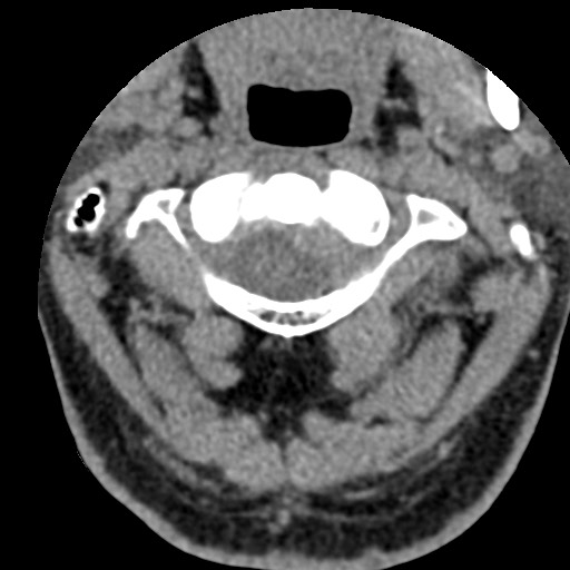 File:Cervical spinal neurofibroma in a patient with NF1 (Radiopaedia 58344-65464 Axial non-contrast 17).jpg