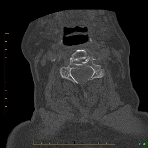 Cervical spine fracture - ankylosing spondylitis (Radiopaedia 76835-88706 Axial bone window 101).jpg