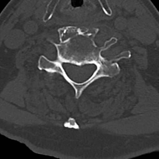File:Cervical spine fracture - chalk stick (Radiopaedia 39116-41323 Axial bone window 60).png