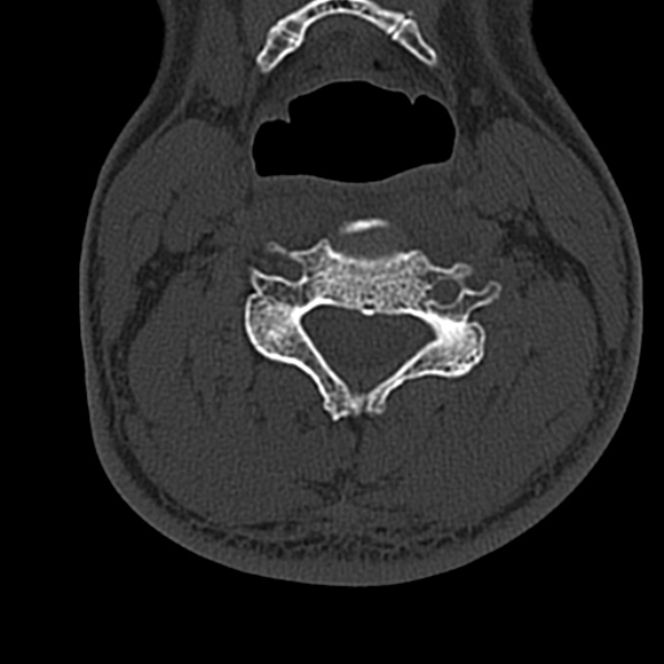 Cervical spondylodiscitis (Radiopaedia 28057-29489 Axial bone window 40).jpg