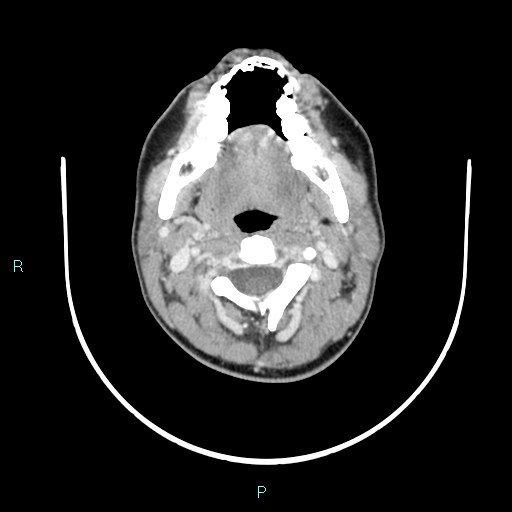 Cervical thymic cyst (Radiopaedia 88632-105335 C 83).jpg