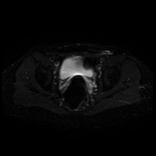 File:Cesarian section scar endometriosis (Radiopaedia 66520-75799 Axial DWI 15).jpg