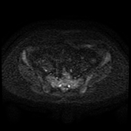 Cesarian section scar endometriosis (Radiopaedia 66520-75799 Axial DWI 54).jpg