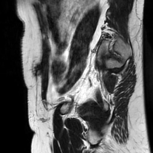 File:Cesarian section scar endometriosis (Radiopaedia 66520-75799 Sagittal T2 11).jpg
