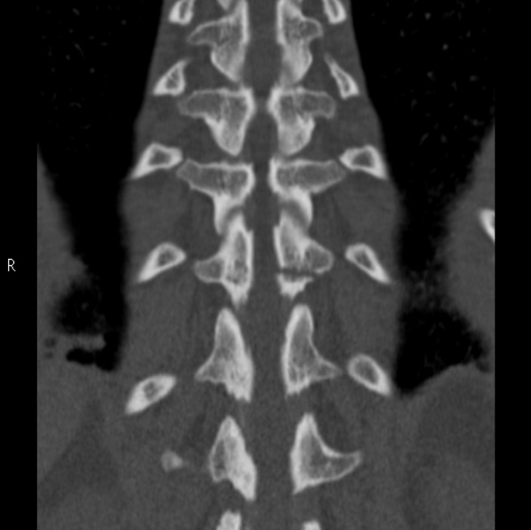 Chance fracture (Radiopaedia 36521-38081 Coronal bone window 46).jpg