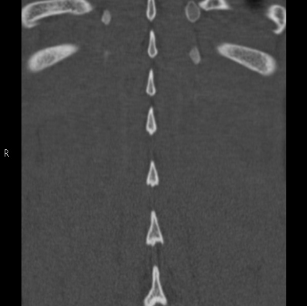 Chance fracture (Radiopaedia 36521-38081 Coronal bone window 58).jpg