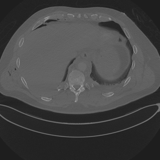 Chest multitrauma - aortic injury (Radiopaedia 34708-36147 Axial bone window 246).png