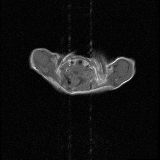 File:Chiari II malformation with spinal meningomyelocele (Radiopaedia 23550-23652 Axial T1 1).jpg
