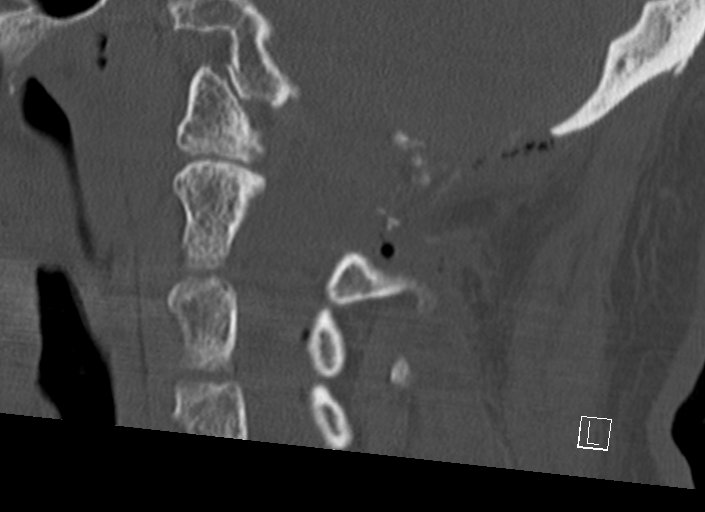 Chiari I malformation with a symptomatic syrinx of the posterolateral medulla oblongata (Radiopaedia 42573-45707 A 25).jpg
