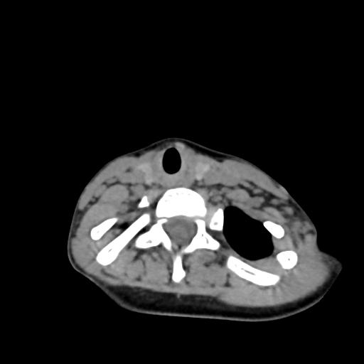 Chiari I with syrinx and skull base anomalies (Radiopaedia 89444-106412 Axial non-contrast 115).jpg