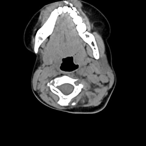 Chiari I with syrinx and skull base anomalies (Radiopaedia 89444-106412 Axial non-contrast 68).jpg