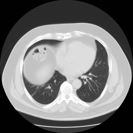 File:Chilaiditi’s syndrome (Radiopaedia 27550-27756 Axial lung window 7).jpg