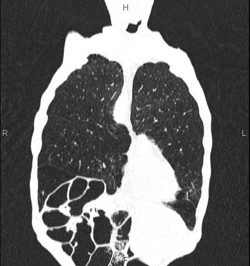 Chilaiditi sign (Radiopaedia 88839-105611 Coronal lung window 13).jpg