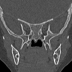 Choanal atresia (Radiopaedia 88525-105975 Coronal bone window 81).jpg