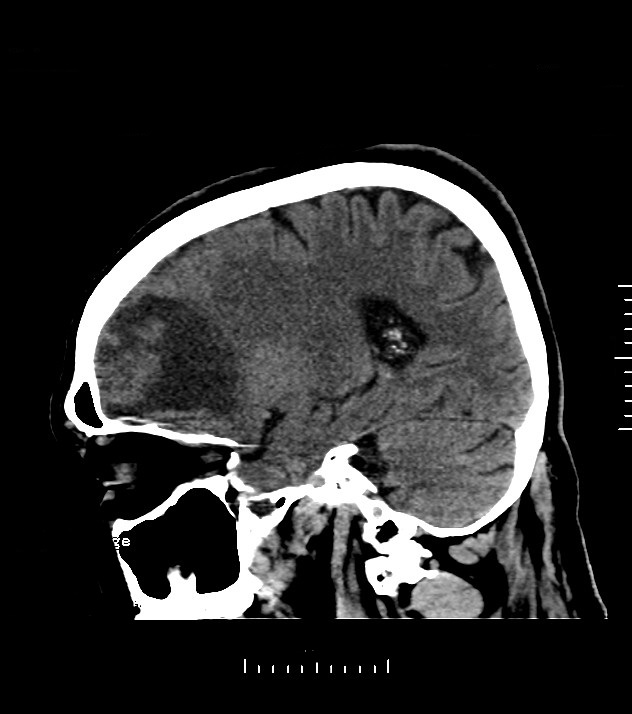 Cholangiocarcinoma with cerebral metastases (Radiopaedia 83519-98628 C 36).jpg