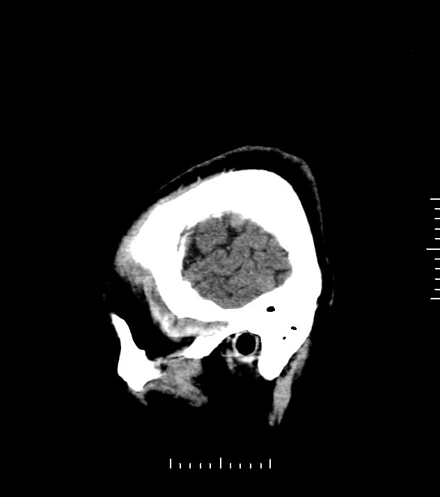 Cholangiocarcinoma with cerebral metastases (Radiopaedia 83519-98628 C 51).jpg