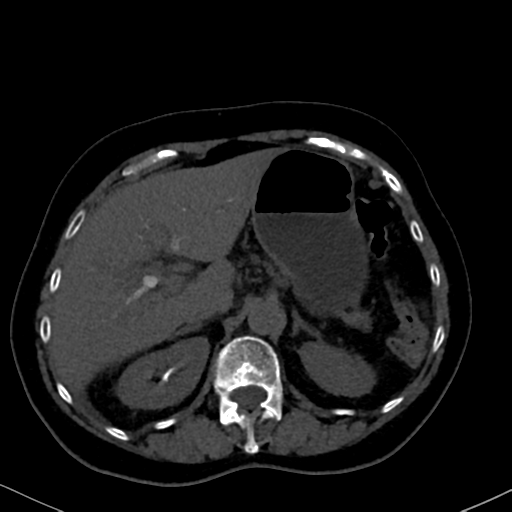 File:Cholecystitis - obstructive choledocholitiasis (CT intravenous cholangiography) (Radiopaedia 43966-47479 Axial 89).png