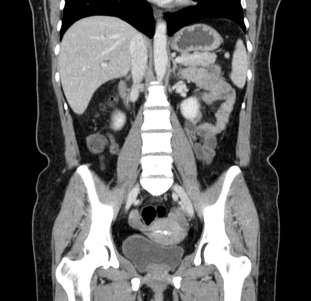 Choledocholithiasis on CT and MRI (Radiopaedia 24825-25087 C 29).jpg