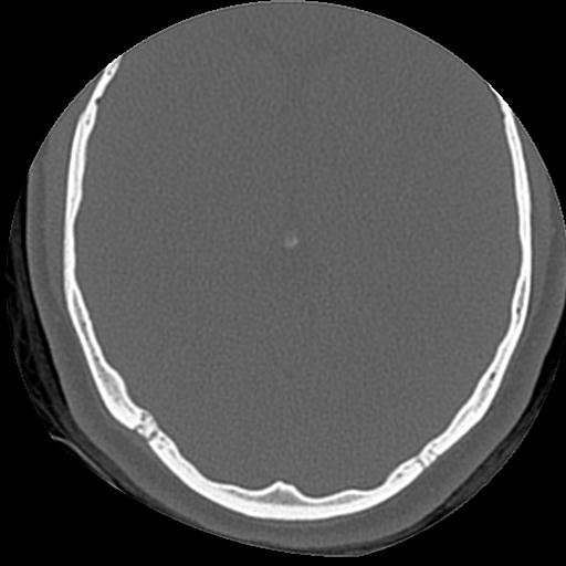 Cholesteatoma (Radiopaedia 84960-100474 Axial bone window 4).jpg