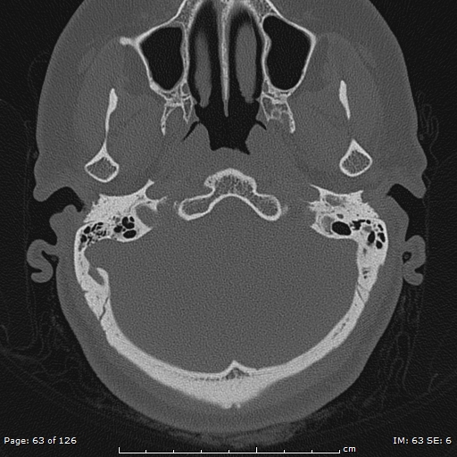 Cholesteatoma - external auditory canal (Radiopaedia 88452-105096 Axial bone window 26).jpg