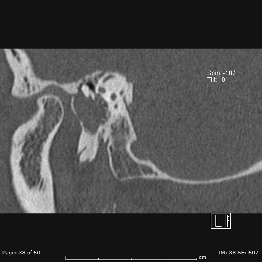 Cholesteatoma - external auditory canal (Radiopaedia 88452-105096 Sagittal bone window 38).jpg