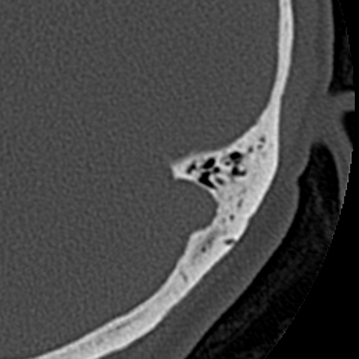 File:Cholesteatoma of the external ear (Radiopaedia 16540-16225 Axial bone window 4).jpg