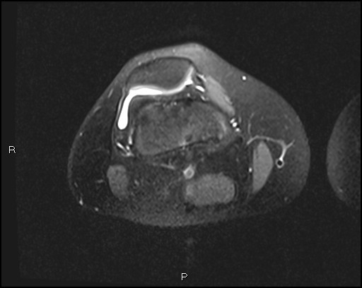 File:Chondroblastoma (Radiopaedia 62721-71031 Axial PD fat sat 10).jpg