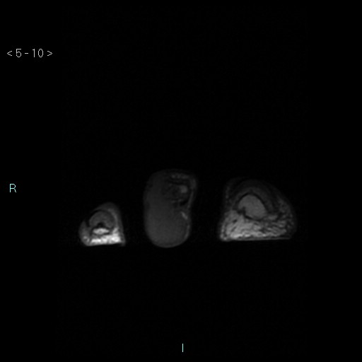 File:Chondrosarcoma - phalanx (Radiopaedia 69047-78813 Axial T1 10).jpg