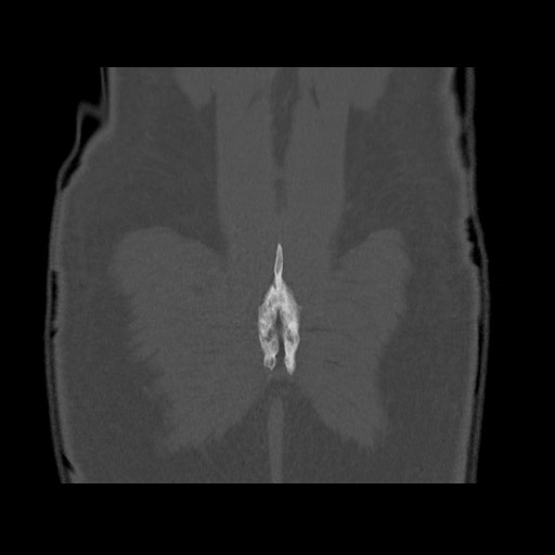 Chondrosarcoma of iliac wing (Radiopaedia 63861-72599 Coronal bone window 104).jpg