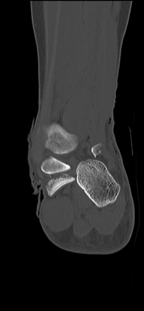 Chopart fracture (Radiopaedia 35347-36851 Coronal bone window 22).jpg