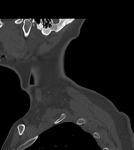 File:Chordoma (C4 vertebra) (Radiopaedia 47561-52188 Sagittal bone window 4).png