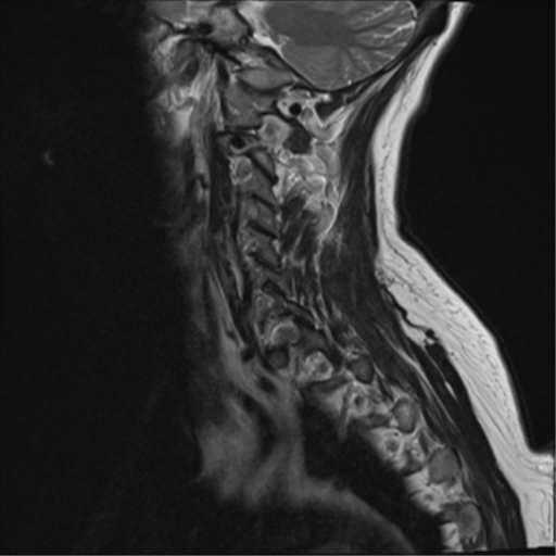 File:Chordoma (C4 vertebra) (Radiopaedia 47561-52189 Sagittal T2 1).png